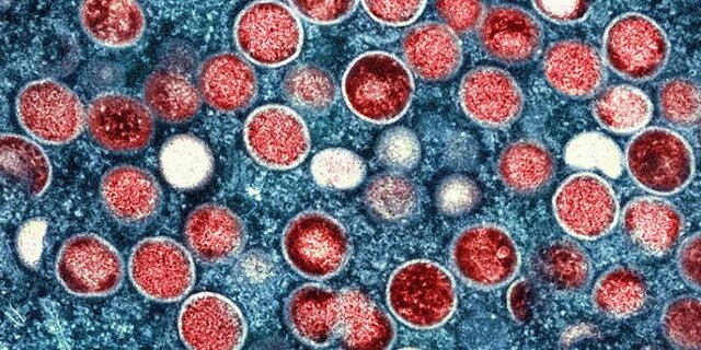 Nota de Esclarecimento da Secretaria de Estado da Saúde de Rondônia (Sesau)  sobre 4 casos de vírus Mpox - Gente de Opinião