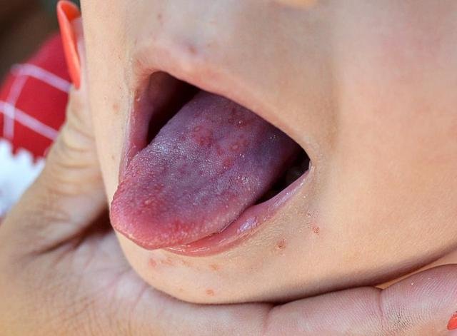 Registrados pelo menos 100 casos da doença mão-pé-boca em Rolim de Moura - Gente de Opinião