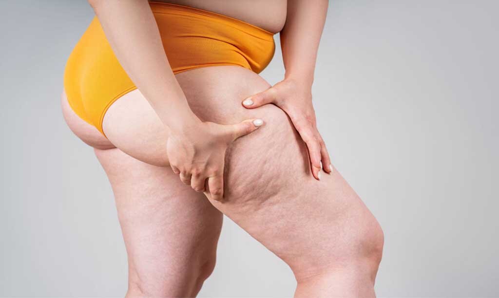 Além do Inchaço: Entendendo o Lipedema - Gente de Opinião