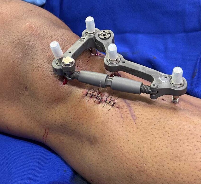 Irmãos maçons protagonizam cirurgia inédita de correção de joelho em Porto Velho - Gente de Opinião
